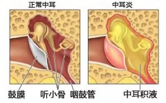 中耳炎都有什么危害