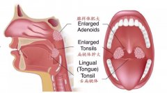 重庆耳鼻喉医院排名_怎么预防腺样体肥大