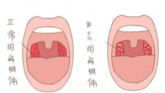 重庆好的耳鼻喉医院_扁桃体炎的病因有哪些