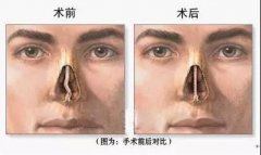 耳鼻喉科重庆医院那里好_鼻中隔偏曲的常见症状
