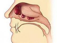 重庆耳鼻喉科医院排名_鼻息肉的常见症状