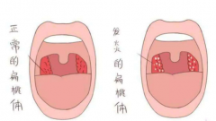 重庆耳鼻喉科医院排名_扁桃体炎有哪些症状表现
