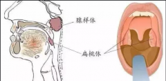 重庆耳鼻喉科哪个医院好_扁桃体肥大有什么症状