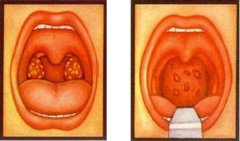 重庆耳鼻喉科医院排名_腺样体肥大对孩子的危害