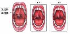 重庆耳鼻喉医院排行_扁桃体炎的症状表现