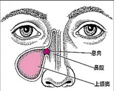 重庆耳鼻喉科医院排名_ 鼻息肉的症状及治疗方法