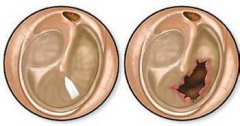鼓膜穿孔的常见原因-重庆仁品耳鼻喉医院