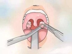 小儿扁桃体炎的护理方法-重庆耳鼻喉科医院