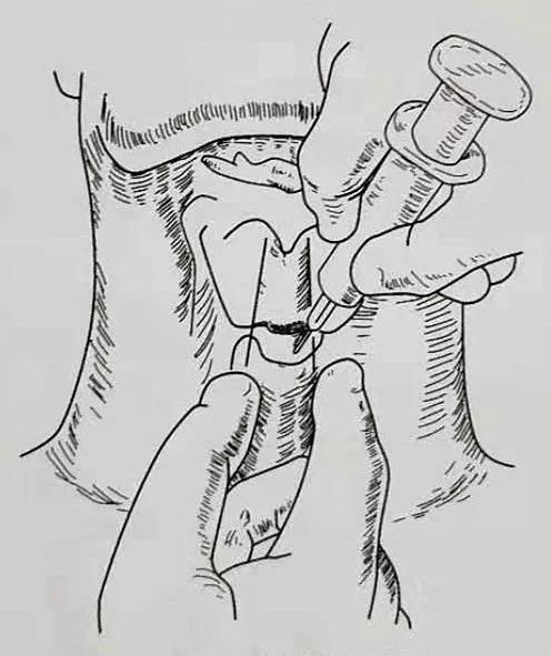 图一环甲膜穿刺术大直径带注射器穿刺针穿刺环甲膜，直至能抽出气体，表示针头进入声门下区。