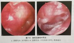 急性化脓性中耳炎的症状及治疗方法