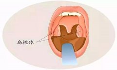 扁桃体切除术后，容易患上呼吸道感染吗？