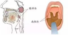 家长必看！“腺样体长大就萎缩”，这句话到底害了多少孩子！ ​