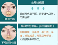 重庆耳鼻喉科医院排名_鼻中隔偏曲前期症状是什么？