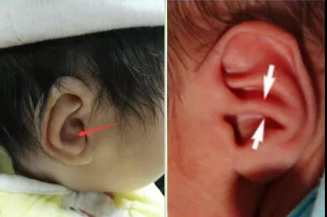  耳廓形态畸形之 耳甲腔畸形,耳廓形态畸形之 耳界角异常横突