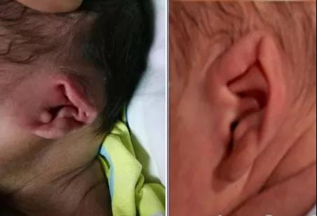 耳廓形态畸形之 混合畸形 ,耳廓形态畸形之混合畸形