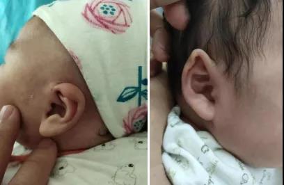 耳廓形态畸形之垂耳 , 耳廓形态畸形之耳轮畸形