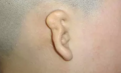 小耳畸形患者听力受影响吗？