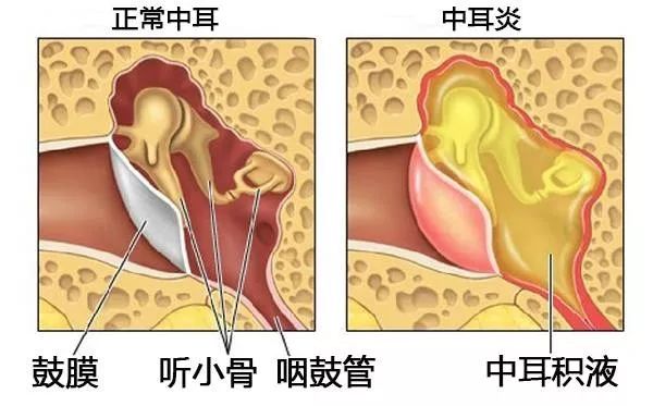 慢性化脓性中耳炎是怎么回事