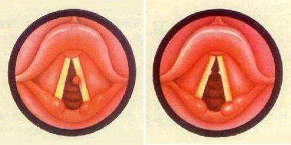 引起声带息肉的原因有哪些