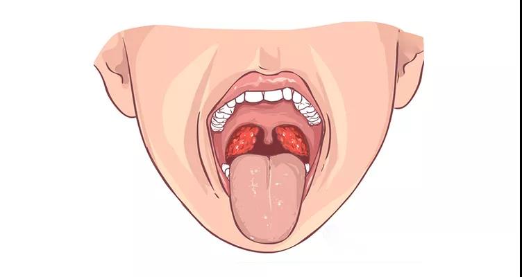 扁桃体炎的危害