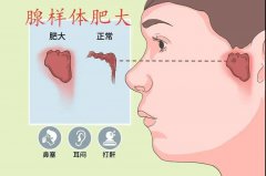 孩子睡觉打鼾，常常张口呼吸是咋回事？