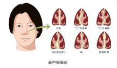 鼻中隔偏曲的症状表现，鼻中隔偏曲一定要手术吗?