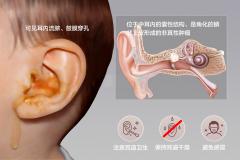 中耳流脓、听力下降？小心中耳胆脂瘤