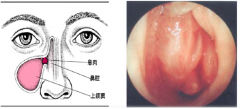鼻息肉的症状有哪些？