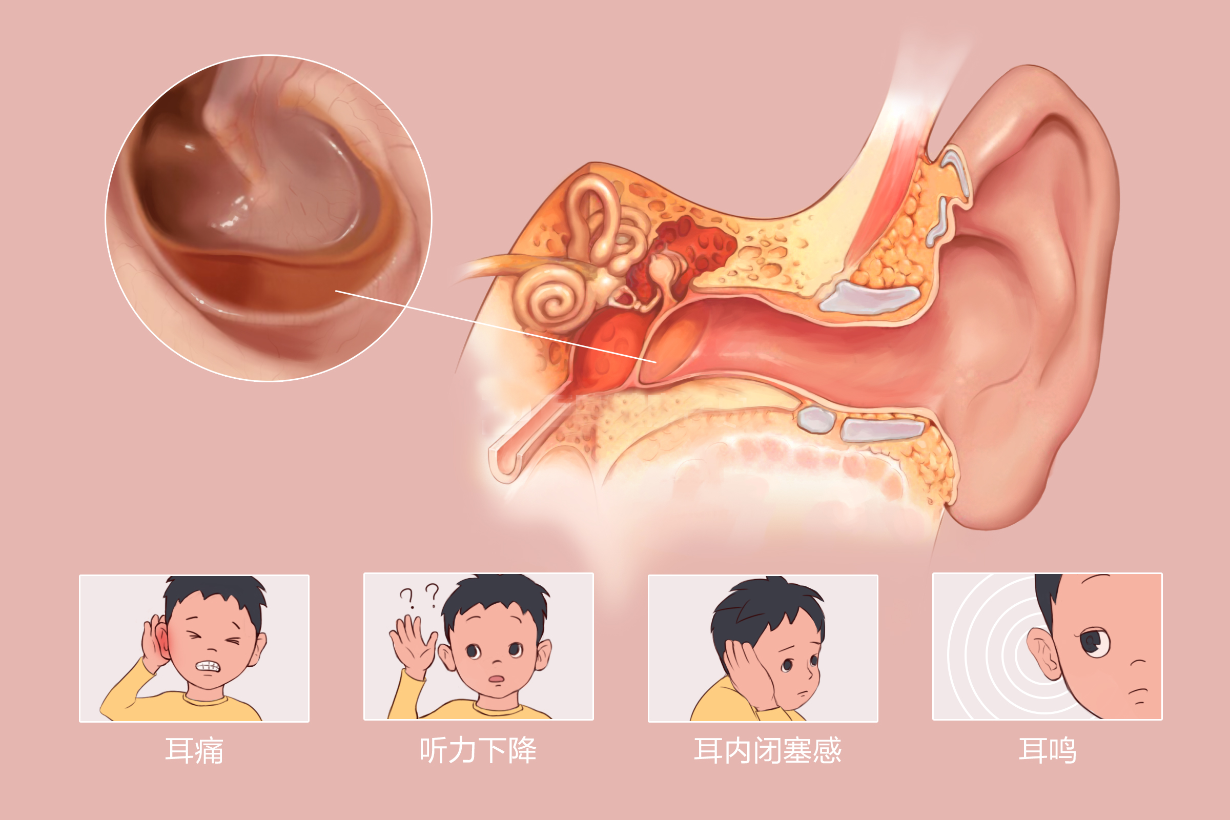 中耳炎