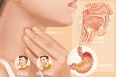 别再把反流性咽喉炎当慢性咽炎了