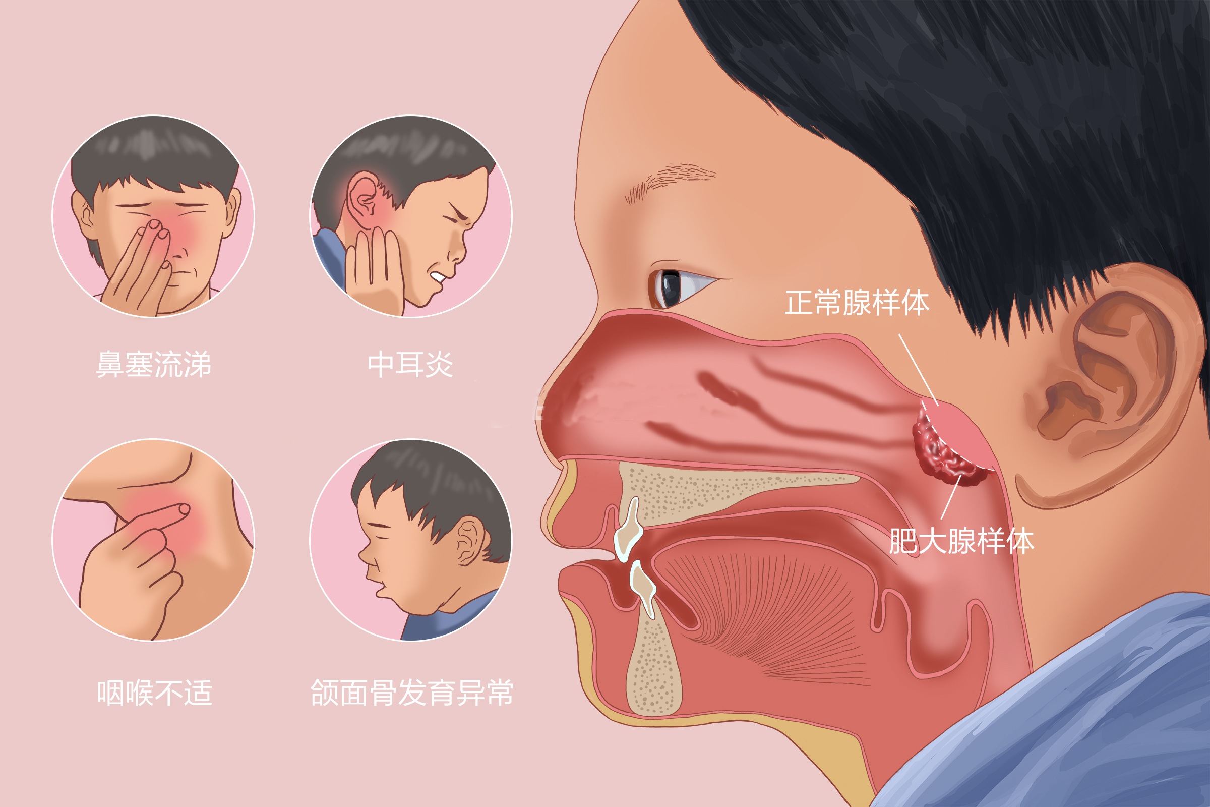 重庆治疗腺样体肥大专科医院