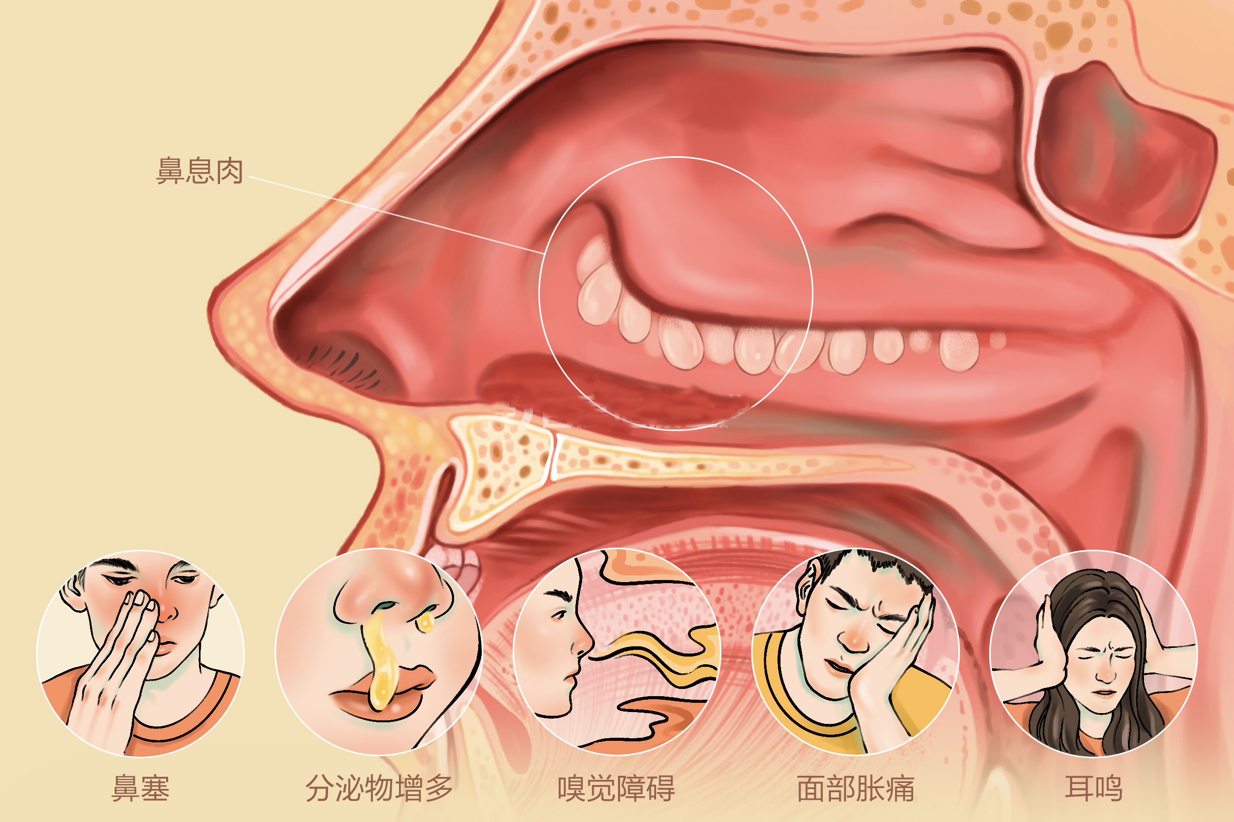 鼻息肉的治疗方法